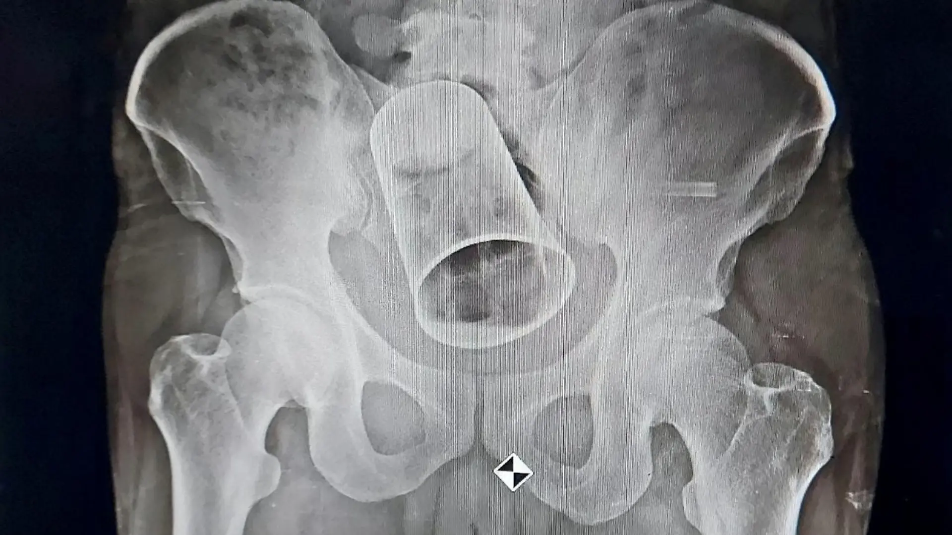 SONDERKONDITIONEN: Satzpreis!
Doctors have removed a steel cup from a man's bottom - after his friends put it up there as a drunken prank. See SWNS story SWFSsteel. The 45-year-old from Balipadar, India, had the substantially sized tumbler removed via surgery at a local hospital. The incident, which took place 19 August, happened when the unfortunate man was out drinking with his friends in Surat, Gujarat. According to reports, the victim's 'friends' inserted the sizeable item up his anus whilst he was in an ''inebriated state''. An X-Ray was done at MKCG Medical College and Hospital at Berhampur city, and the glass was found stuck in the intestine. At first, the doctors tried to retrieve the glass through rectum but then resorted to surgery due to the sheer size of the glass. Doctors had to cut through the intestine to retrieve the object. The unlucky man is recovering after the surgery and his condition is said to be stable. / action press