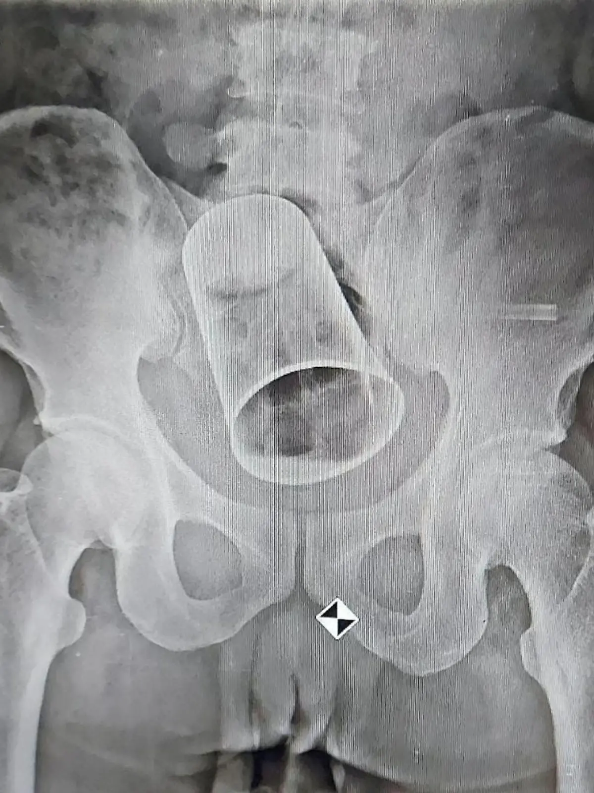 SONDERKONDITIONEN: Satzpreis!
Doctors have removed a steel cup from a man's bottom - after his friends put it up there as a drunken prank. See SWNS story SWFSsteel. The 45-year-old from Balipadar, India, had the substantially sized tumbler removed via surgery at a local hospital. The incident, which took place 19 August, happened when the unfortunate man was out drinking with his friends in Surat, Gujarat. According to reports, the victim's 'friends' inserted the sizeable item up his anus whilst he was in an ''inebriated state''. An X-Ray was done at MKCG Medical College and Hospital at Berhampur city, and the glass was found stuck in the intestine. At first, the doctors tried to retrieve the glass through rectum but then resorted to surgery due to the sheer size of the glass. Doctors had to cut through the intestine to retrieve the object. The unlucky man is recovering after the surgery and his condition is said to be stable.  / action press