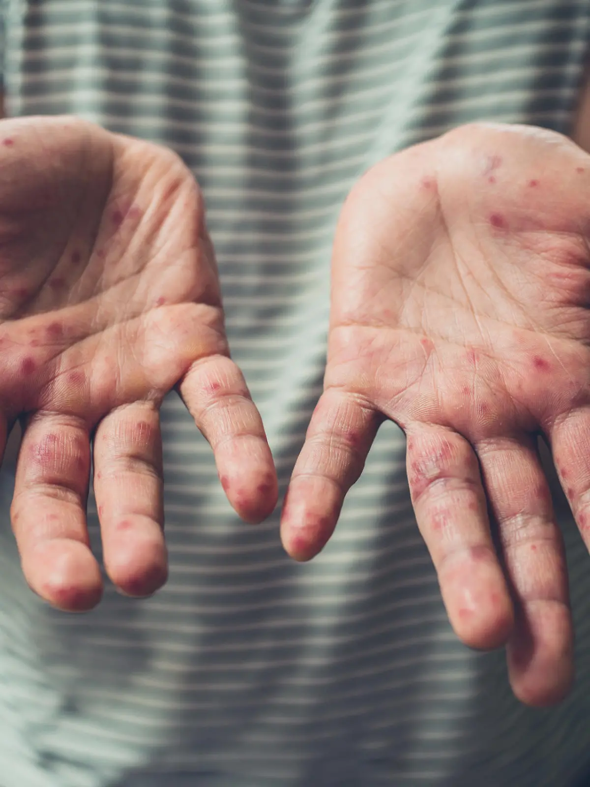 Hautausschlag an den Händen ist eines typischen Symptome der Hand-Fuß-Mund-Krankheit