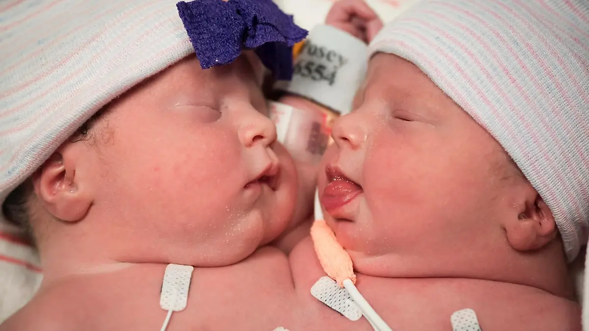 Siamesische Zwillinge Callie und Carter