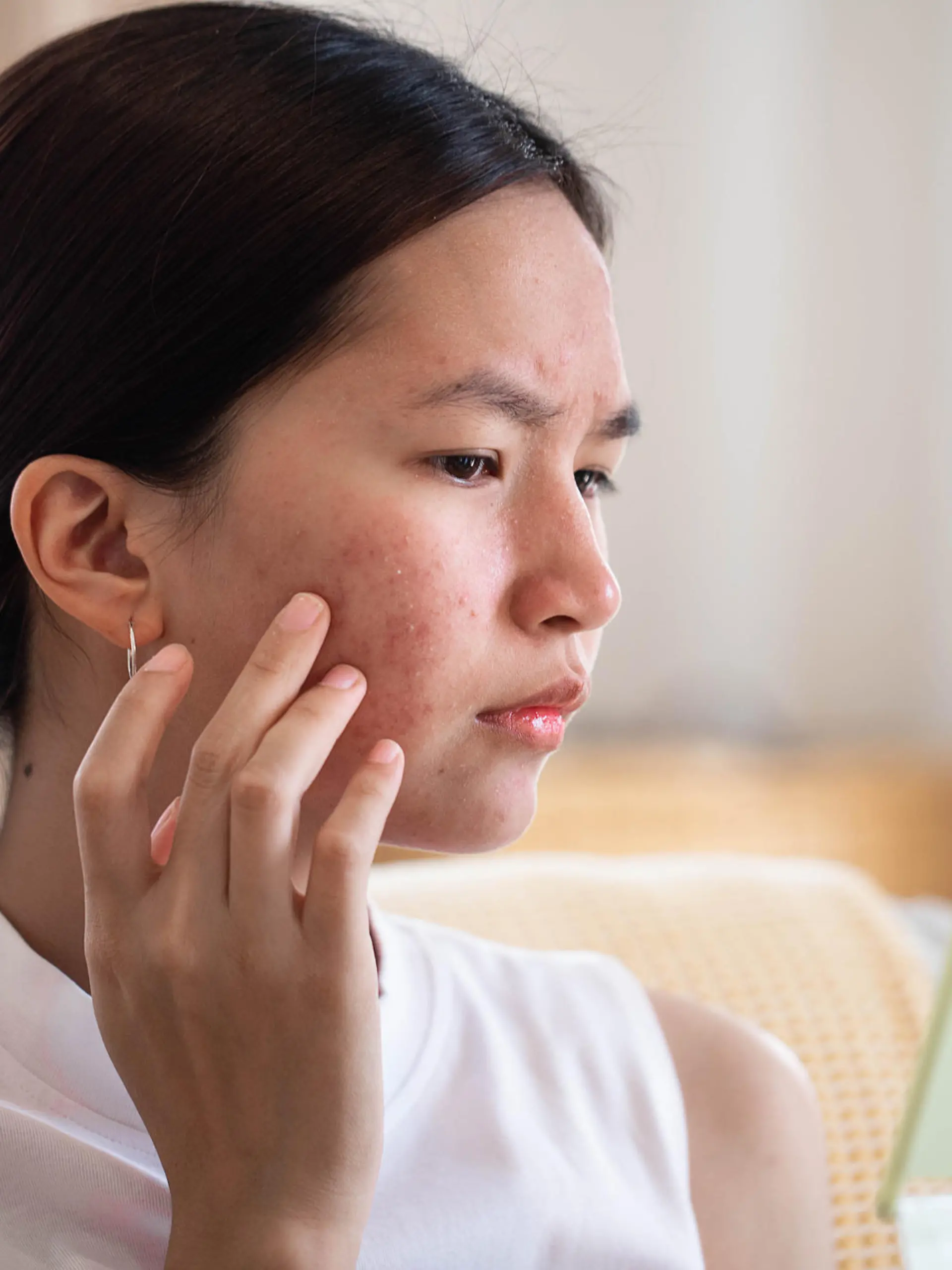 Portrait of Asian woman worry about her face when she saw the problem of acne inflammation and scar by the mini mirror.