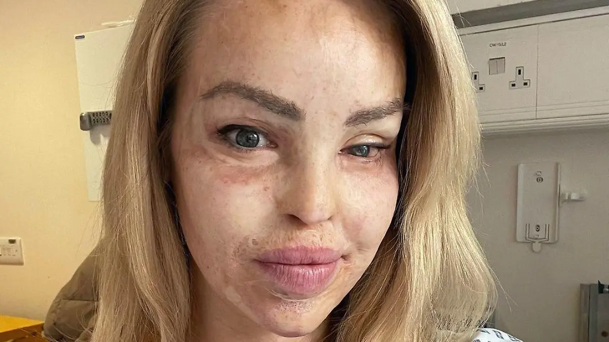 Katie Piper wurde 2008 Opfer eines Säureangriffs.