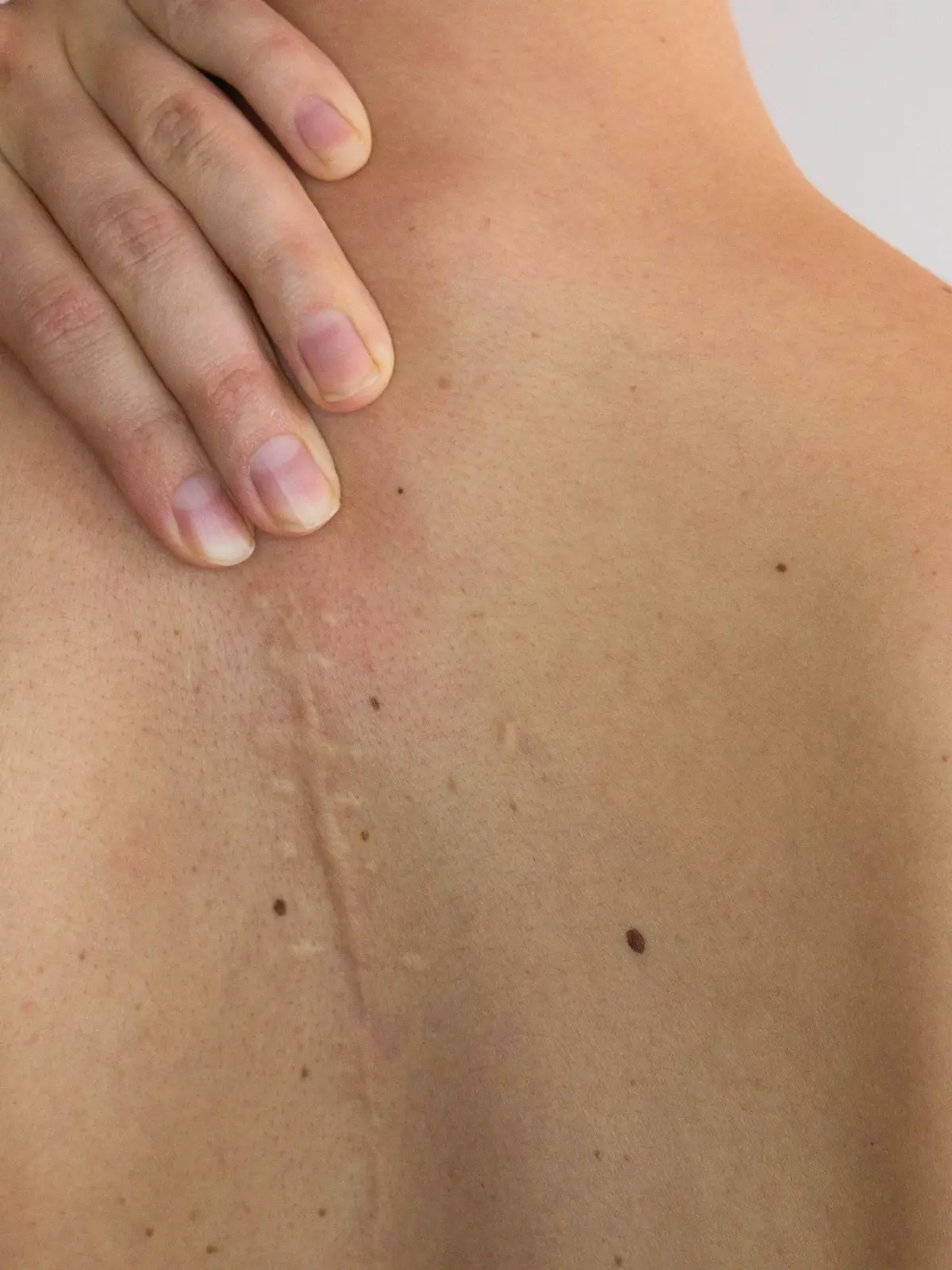 Caucasian woman's upper back with a scar.