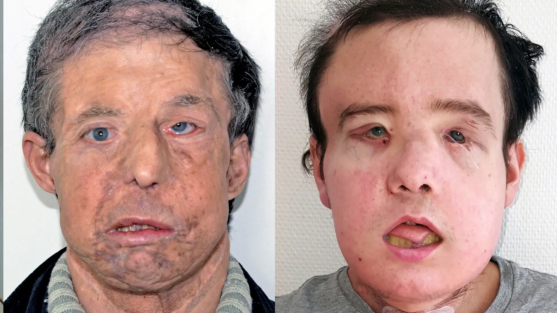 In this undated combination handout photo provided on Tuesday, April 17, 2018 by HEGP AP-HP, Jerome Hamon before and after two transplants. In a medical first, a French surgeon says he has performed a second face transplant on the same patient _ who is now doing well and even spent a recent weekend in Brittany. Dr. Laurent Lantieri of the Georges Pompidou hospital in Paris first transplanted a new face onto Jerome Hamon in 2010. But after getting ill in 2015, Hamon was given drugs that interfered with anti-rejection medicines he was taking for his face transplant. (HEGP AP-HP via AP)