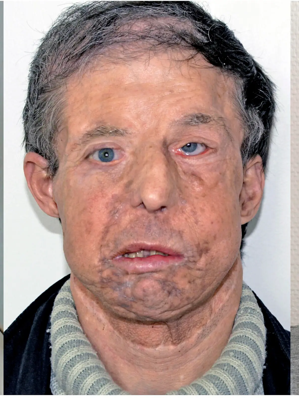 In this undated combination handout photo provided on Tuesday, April 17, 2018 by HEGP AP-HP,  Jerome Hamon before and after two transplants. In a medical first, a French surgeon says he has performed a second face transplant on the same patient _ who is now doing well and even spent a recent weekend in Brittany. Dr. Laurent Lantieri of the Georges Pompidou hospital in Paris first transplanted a new face onto Jerome Hamon in 2010. But after getting ill in 2015, Hamon was given drugs that interfered with anti-rejection medicines he was taking for his face transplant. (HEGP AP-HP via AP)