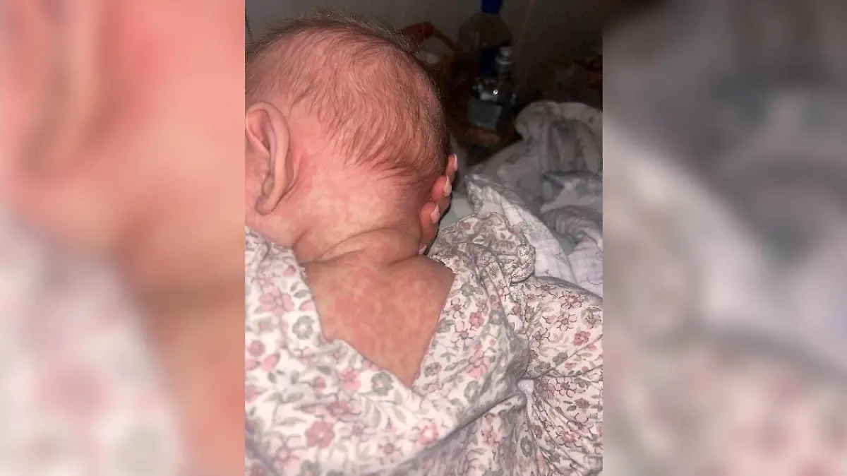 Margot hat den typischen Masern-Ausschlag: Er beginnt meist hinter den Ohren und breitet sich dann über das Gesicht, den Rumpf sowie Arme und Beine aus.