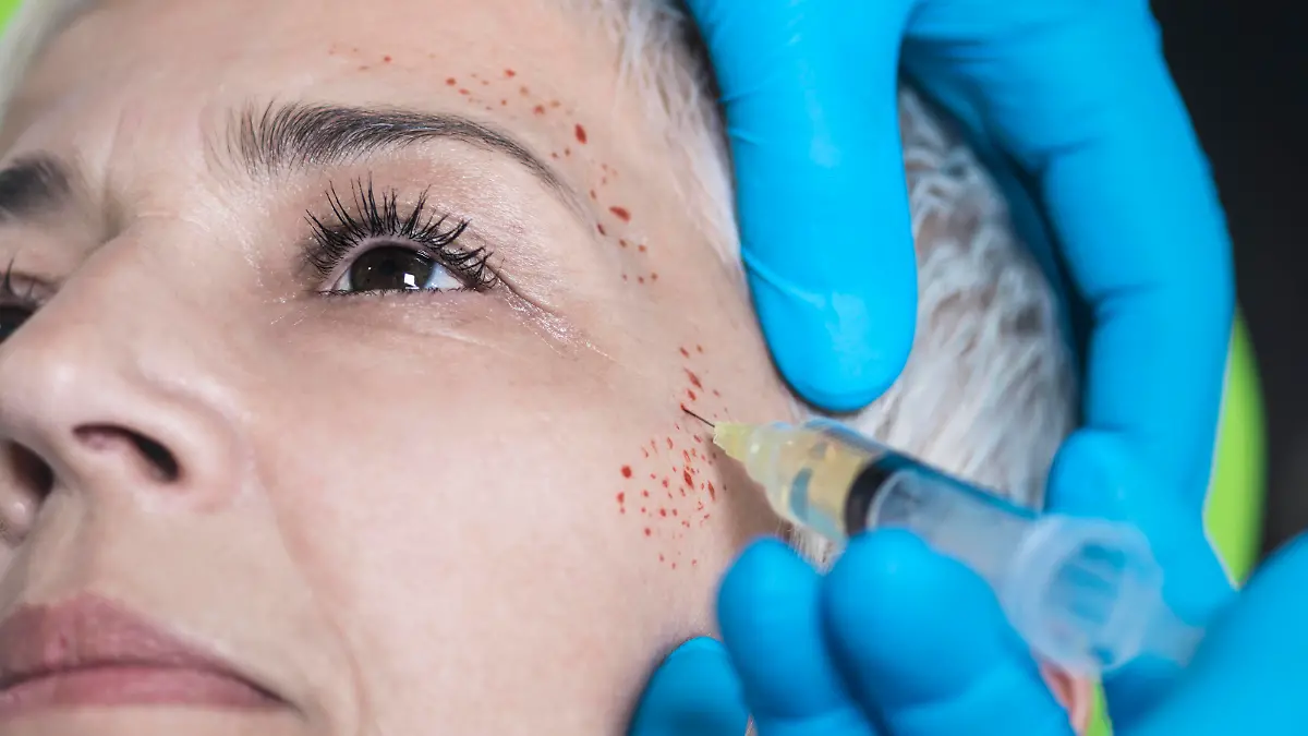 Platelet-rich plasma facial treatment. Close-up of mature woman receiving platelet-rich plasma injections for reducing wrinkles. || Modellfreigabe vorhanden / Mindestpreis 25 Euro