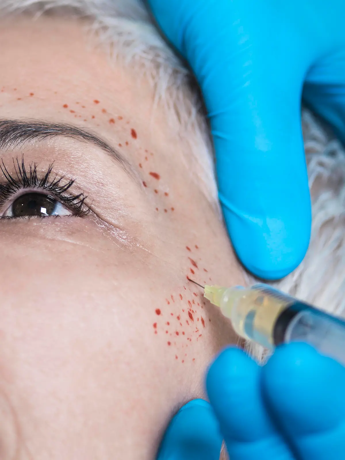 Platelet-rich plasma facial treatment. Close-up of mature woman receiving platelet-rich plasma injections for reducing wrinkles. || Modellfreigabe vorhanden / Mindestpreis 25 Euro 