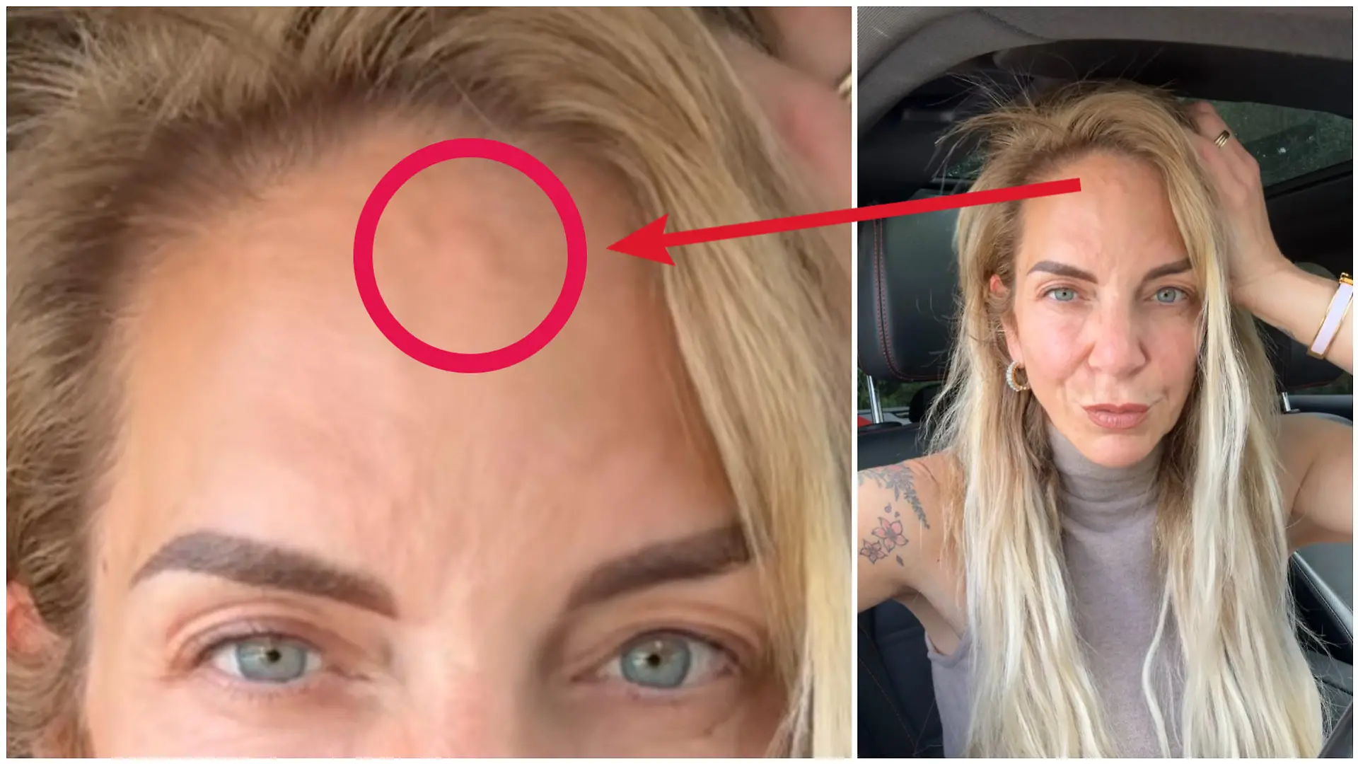 Danni Büchner hat ein Lipom auf der Stirn