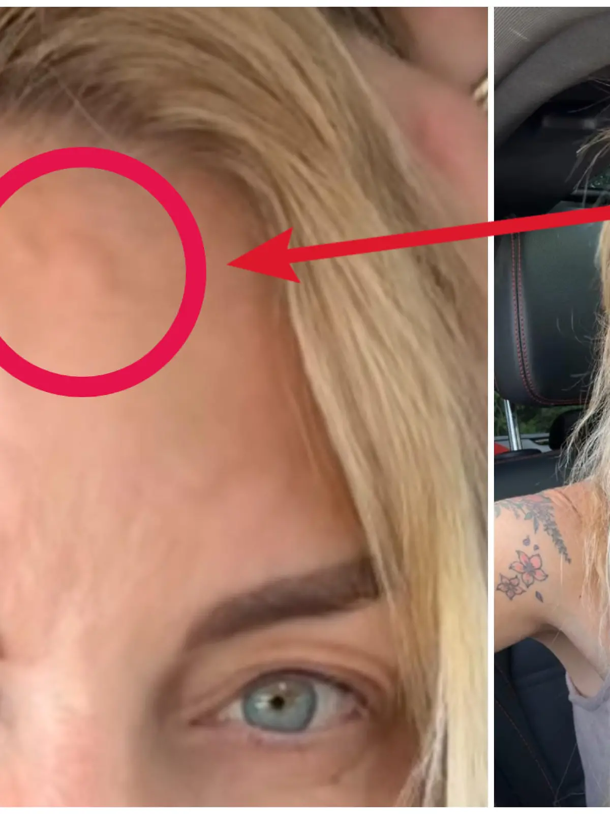 Danni Büchner hat ein Lipom auf der Stirn