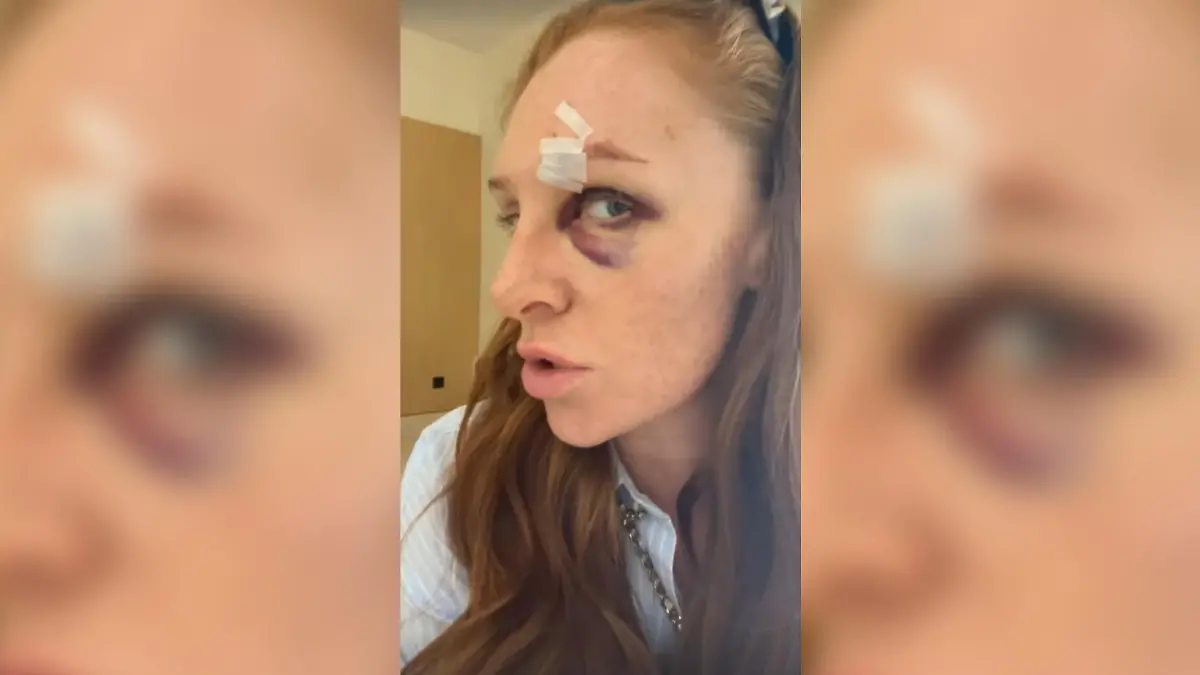 Auf einem neuen Bild zeigt Georgina Fleur das ganze Ausmaß ihrer Verletzung.