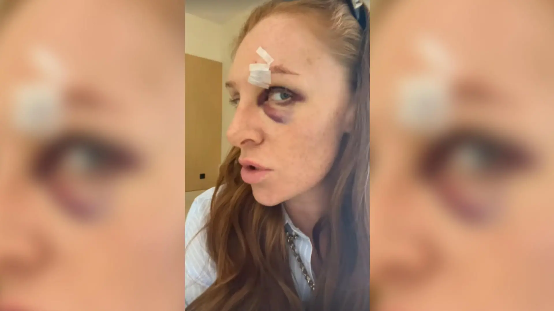 Auf einem neuen Bild zeigt Georgina Fleur das ganze Ausmaß ihrer Verletzung.