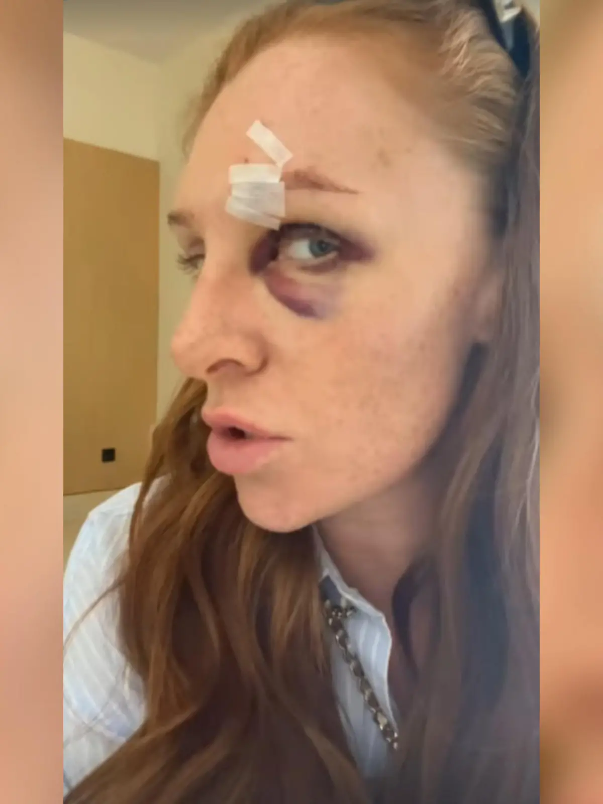 Auf einem neuen Bild zeigt Georgina Fleur das ganze Ausmaß ihrer Verletzung.