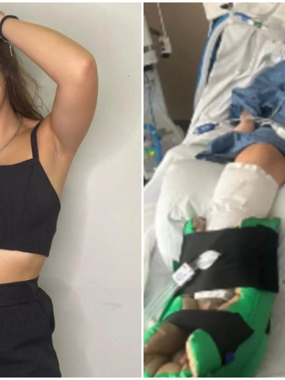 Claudia de Albuquerque Celada (23) erkrankte schwer an Botulismus, einer seltenen bakteriellen Infektion.