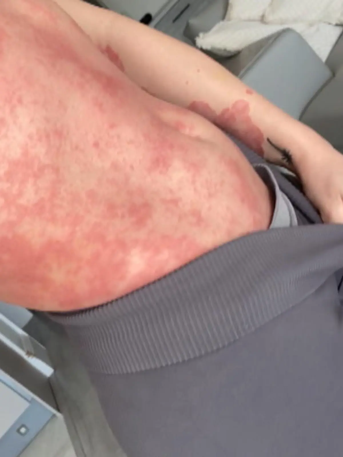Influencerin Rosie Daniel aus Manchester leidet unter Schuppenflechte. Die 22-Jährige geht offen damit. Mehr zu ihr erfahren Sie im Video.