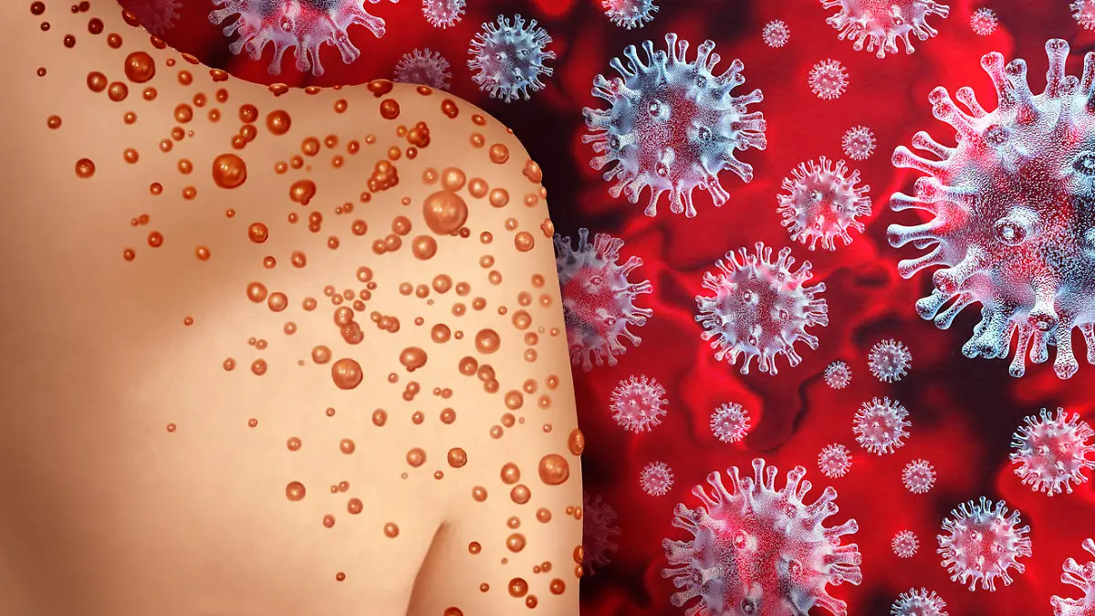Monkeypox Virus Outbreak as a contagious infection as blisters and leisons on the skin representing transmission of an infected person with 3D illustration elements.