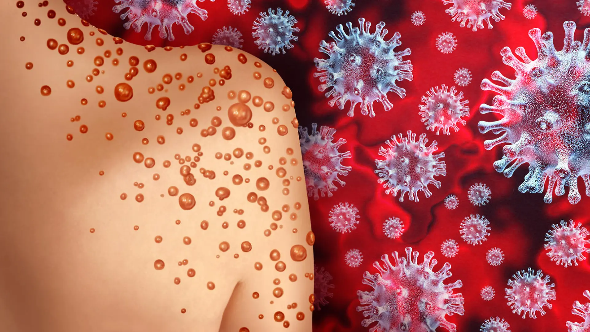 Monkeypox Virus Outbreak as a contagious infection as blisters and leisons on the skin representing transmission of an infected person with 3D illustration elements.
