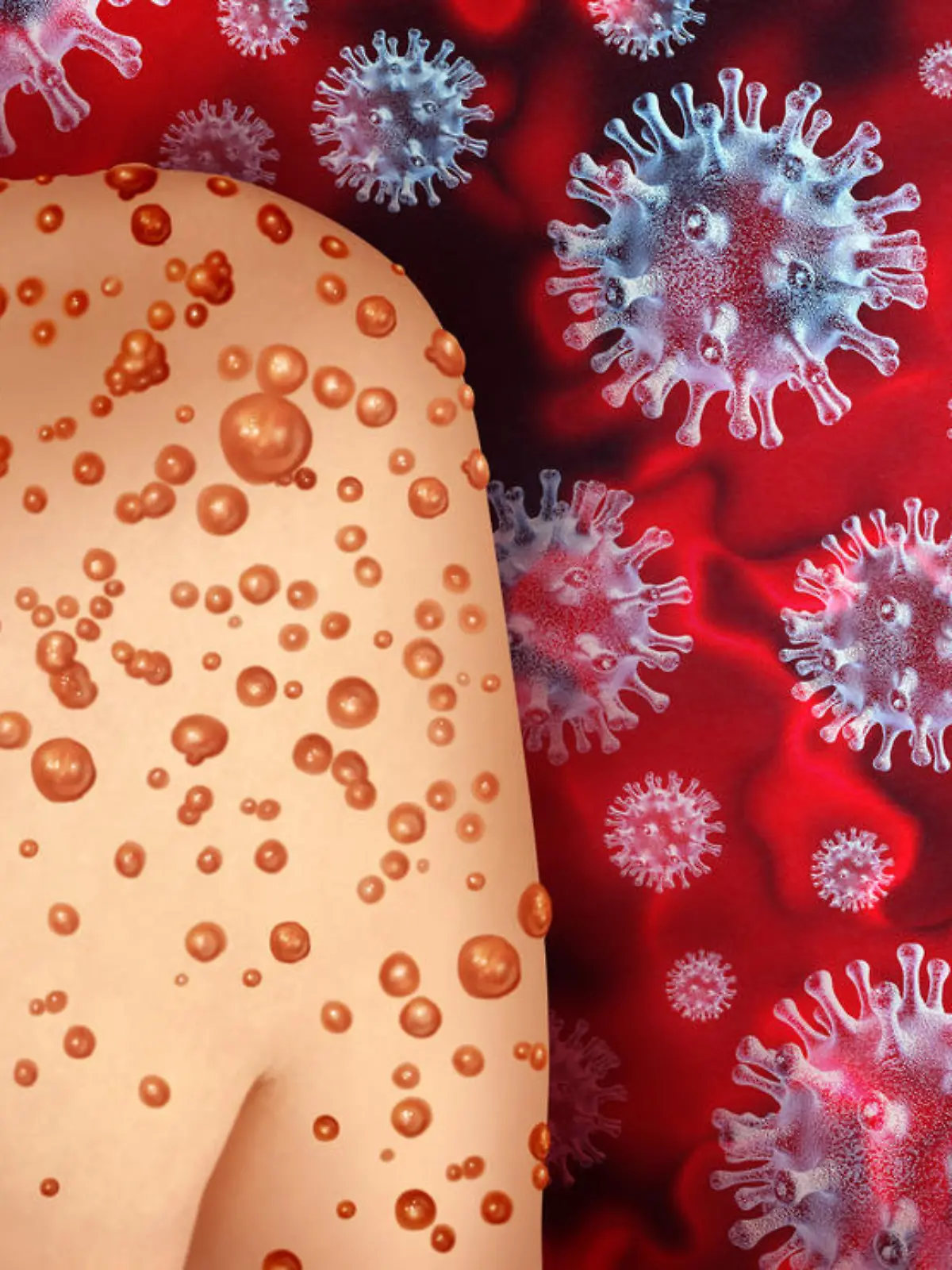 Monkeypox Virus Outbreak as a contagious infection as blisters and leisons on the skin representing transmission of an infected person with 3D illustration elements.