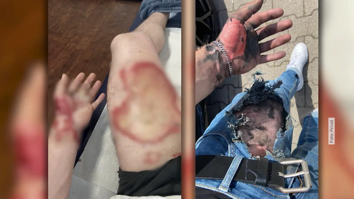 elfbar elfa master akku E-cigarette burns and explosions: How common are vape pen injuries?