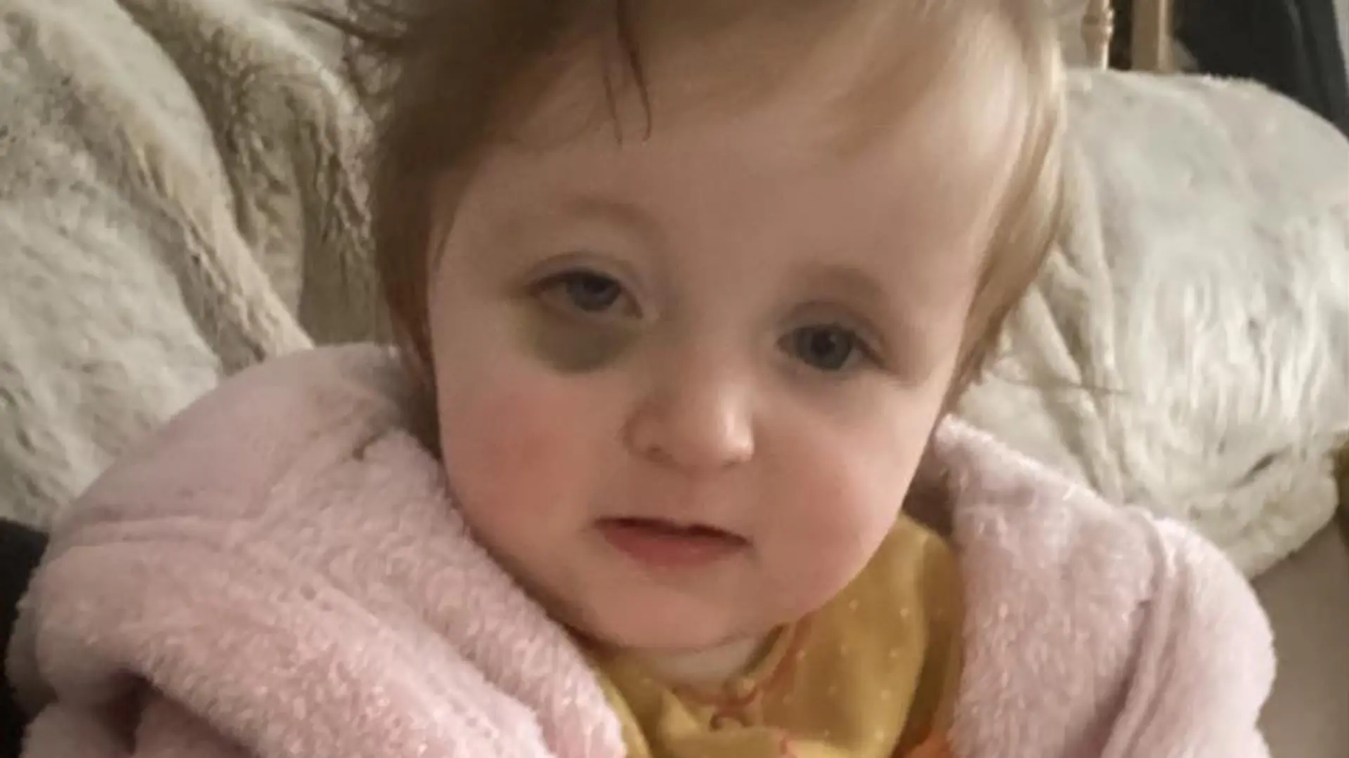 Story from Jam Press (Baby Bruise Cancer)

Pictured: Harper Walker with the bruise developing around her right eye.

‘Bruise on my baby’s eye turned out to be CANCER,’ reveals heartbroken mum

A couple were left devastated after a seemingly innocent bruise on their baby’s eye led to a shocking diagnosis.

Harper Walker was just 13-months-old when, in February 2023, her parents noticed a small bruise under her right eye.

Mum Jenny Huddart, 38, and dad Adam Walker, 36, realised that the dark tinge was growing into a full black eye over the space of a couple of weeks.

After four weeks, they noticed her eye had changed shape and appeared out of alignment with her other eye.

While she remained her usual smiley self, her parents, who are both teachers, were concerned and took her to the GP – who they say didn’t appear worried.

“In general her health has always been fine, she’s usually happy, smiley, and bounces back from bugs relatively quickly,” Jenny, from Swinton, Greater Manchester, told Needtoknow.co.uk.

“We went to see the doctor as soon as we noticed it, but the GP wasn't concerned.

“We re-visited again a couple weeks later, but she asked for us to return again in two weeks.

“However, I rang back afterwards and asked for a referral to an eye specialist, which was scheduled for the end of April.”

But the situation escalated before the appointment, when they noticed her eye further out of alignment.

The worried parents rang 111 and were advised to take the tot to A&E, and then referred to the eye hospital – who ordered scans, ran tests, and got the oncology team involved.

The results came back a few days later, which is when the parents were told it was a stage four, high-risk neuroblastoma – a cancer that develops from immature nerve cells found in several areas of the body.

The doctors explained to Jenny and Adam that the cancer originated in her adrenal gland on her kidney and was now present in her limbs, ribs, hips, skull