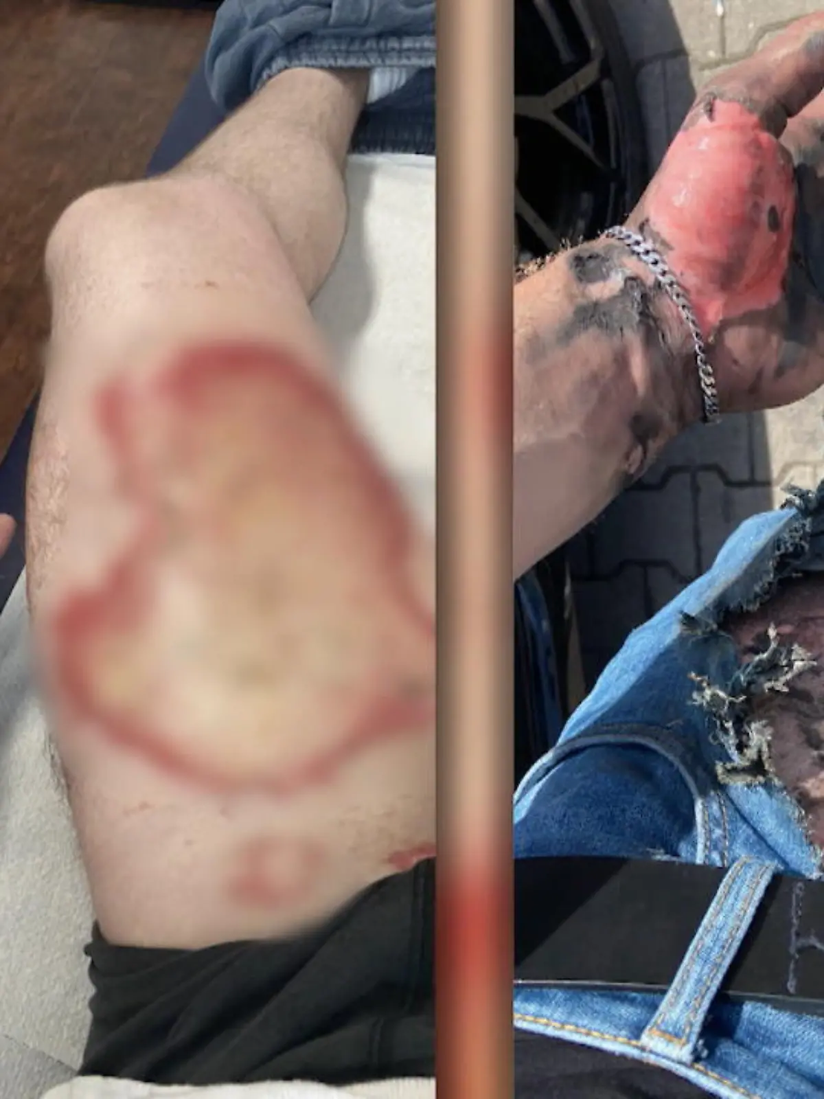Ein Mann aus Ratingen war mit seinem Auto in der Waschstraße und wollte nur noch schnell den Teppich im Fußraum saugen. Dann passierte es! Die E-Zigarette des Vermögensberaters explodiert in seiner Hosentasche. Die Jeans ist völlig zerfetzt, Oberschenkel und Hand sind stark verbrannt.