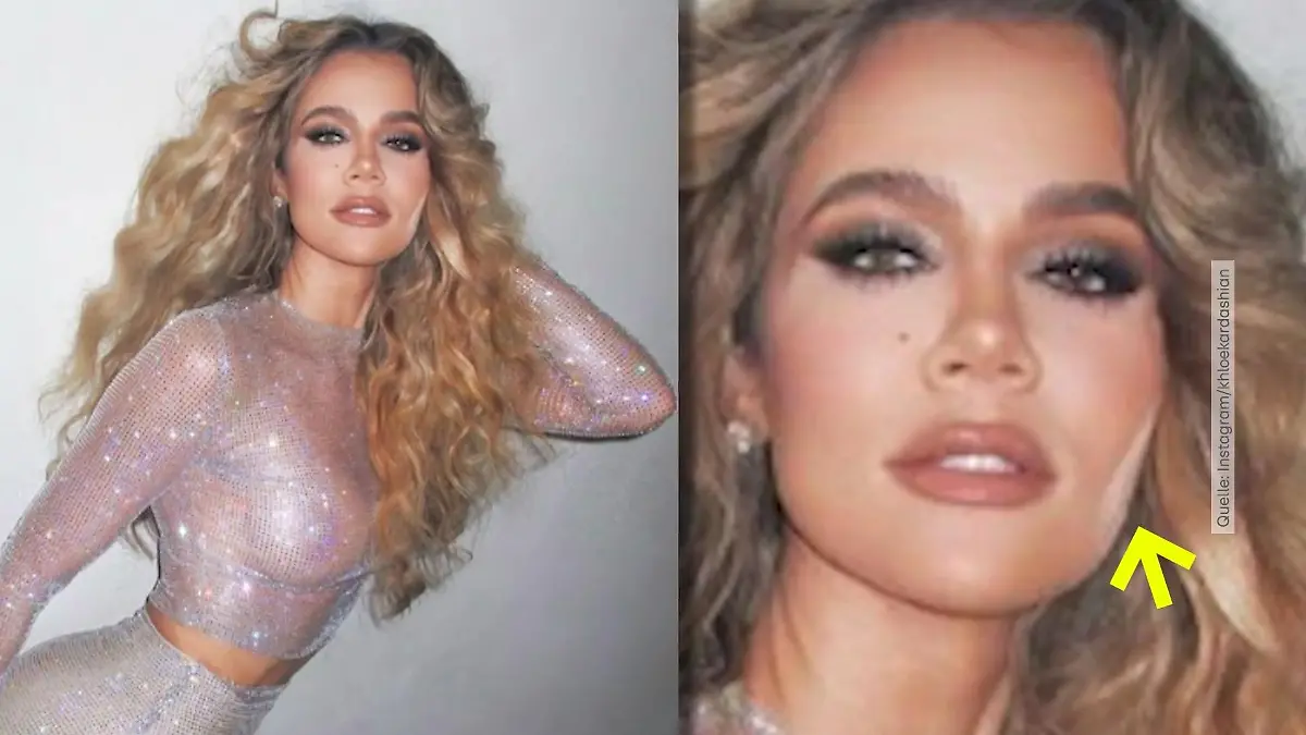 Khloé Kardashian wurde ein Tumor aus dem Gesicht entfernt Wichtiger Appell
