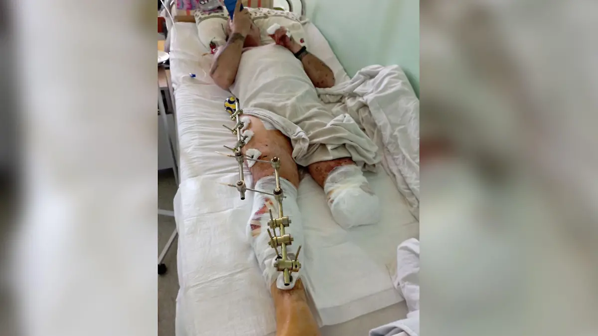 Nach dem Angriff im September verliert Vitali Khomenko zuerst nur ein Bein, das zweite muss ihm in Hannover abgenommen werden.