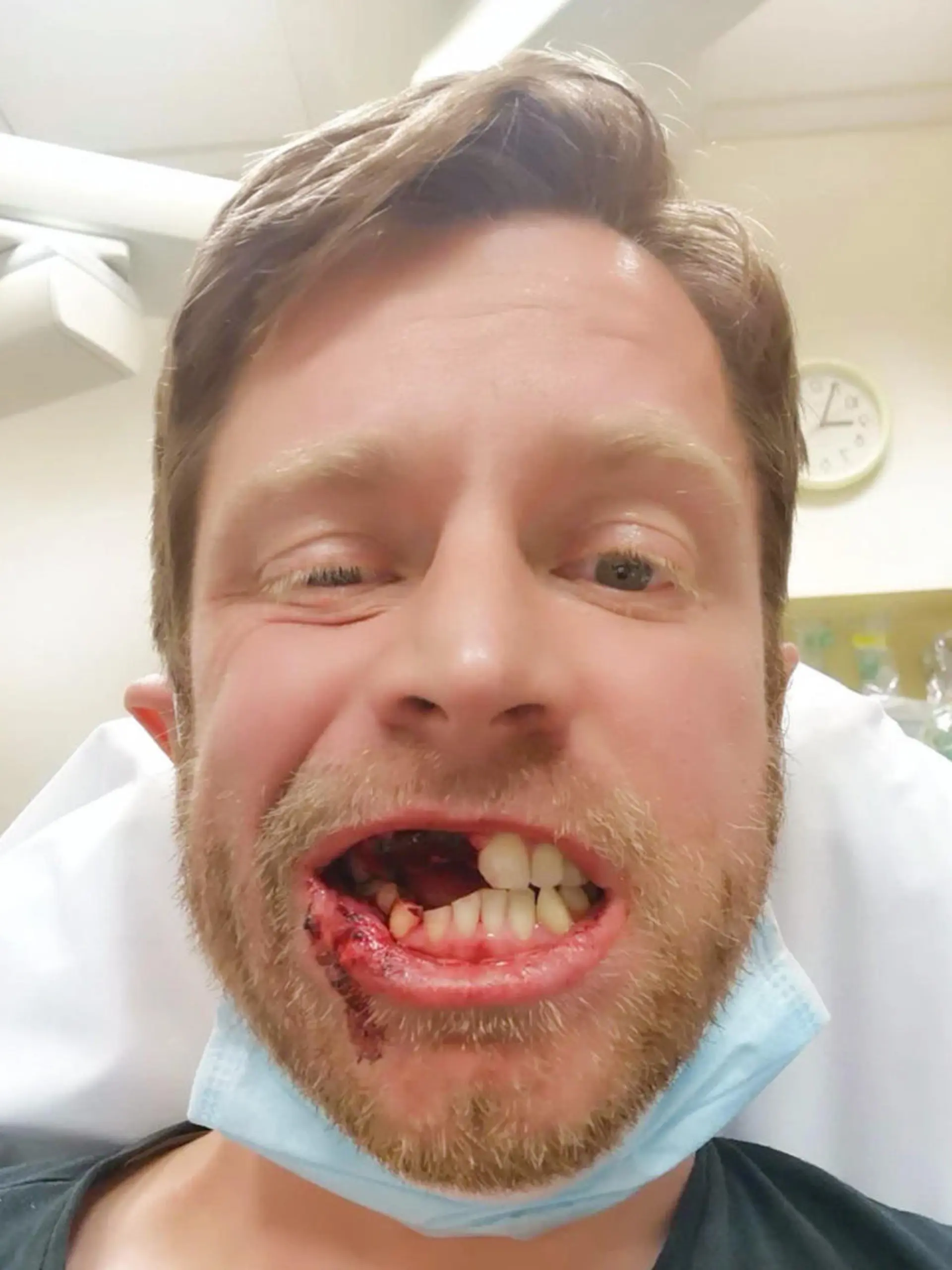 e-Zigarette explodiert im Mund