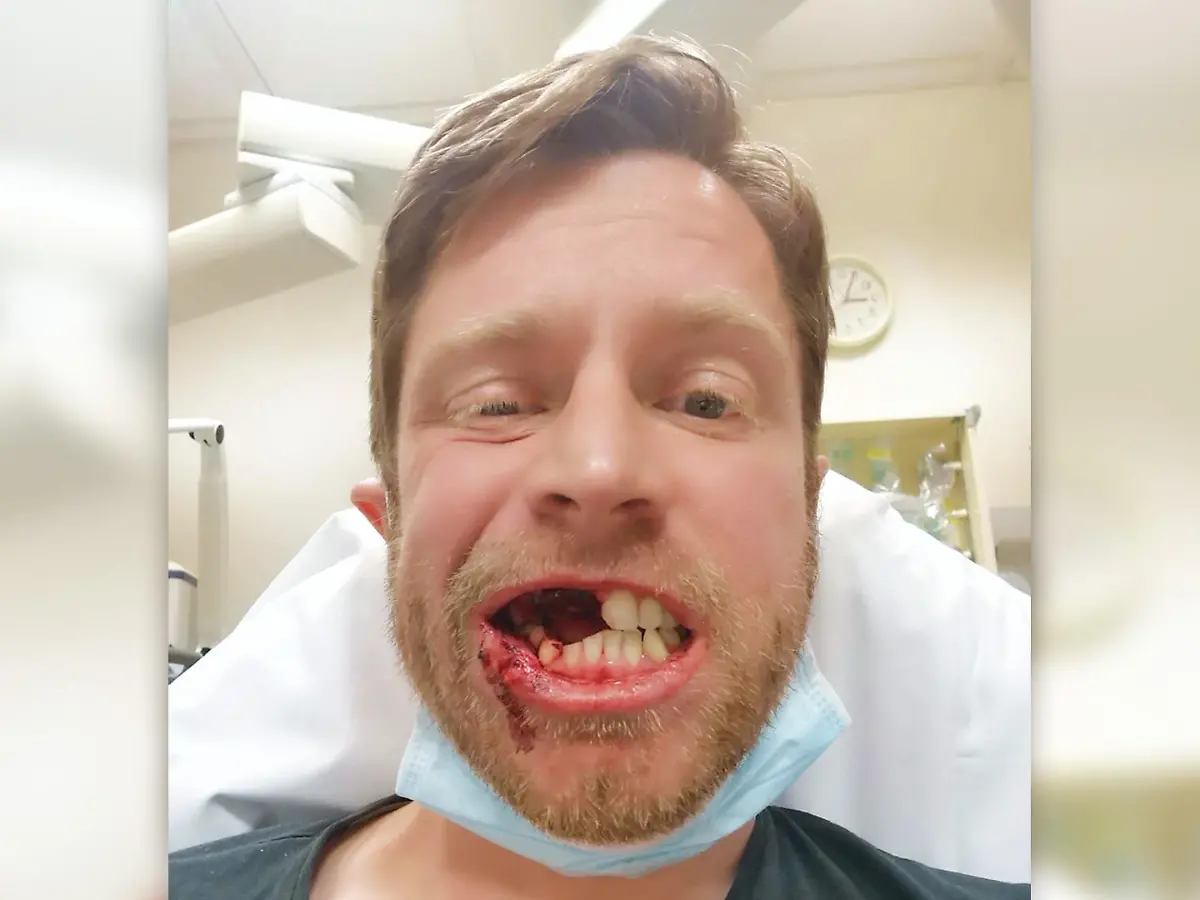 e-zigarette zähne verfärben Die Auswirkungen von Einweg E-Zigaretten auf die Mundgesundheit main image 1