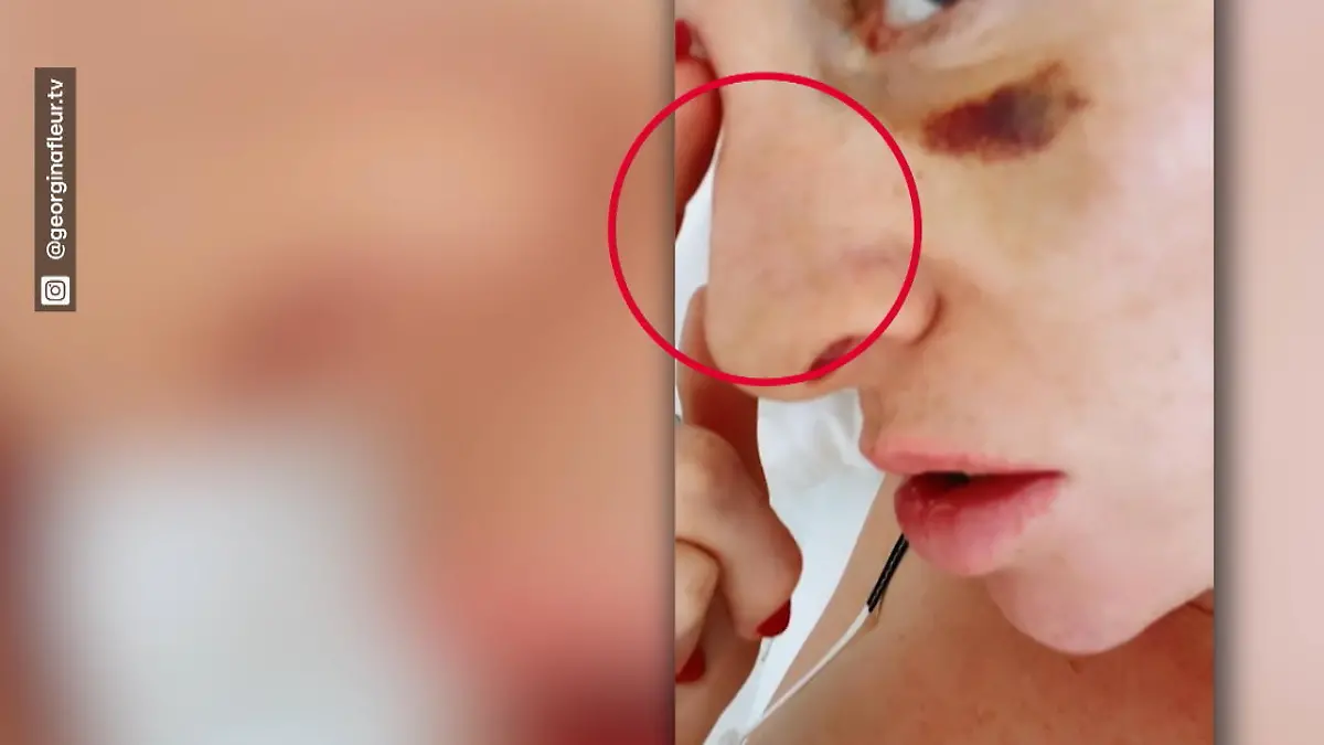 Georgina Fleur gibt Gesichts-Update Nach Schlag von Ex Kubilay