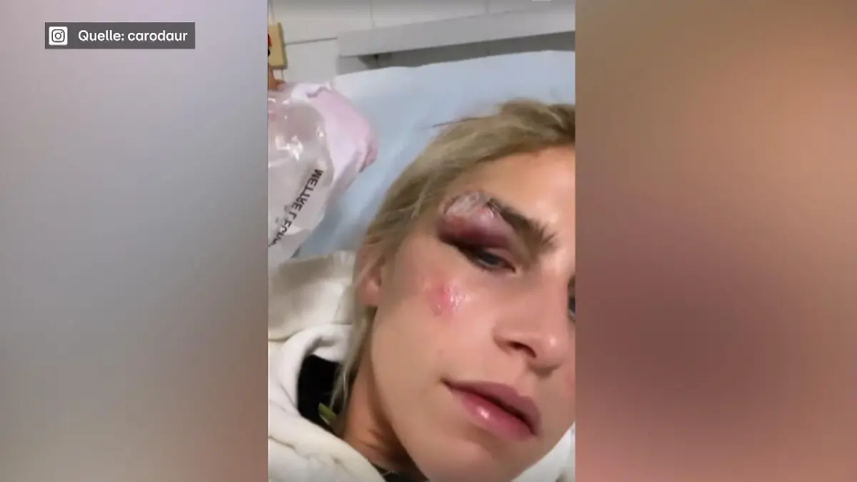 Caro Daur hatte blutigen Jogging-Unfall Sie musste genäht werden