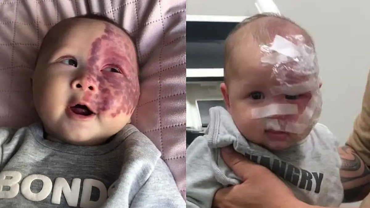 Baby Kingsley wird das Feuermal gelasert - aus präventiven Gründen. Bei TikTok erntet die Mutter deswegen Kritik.