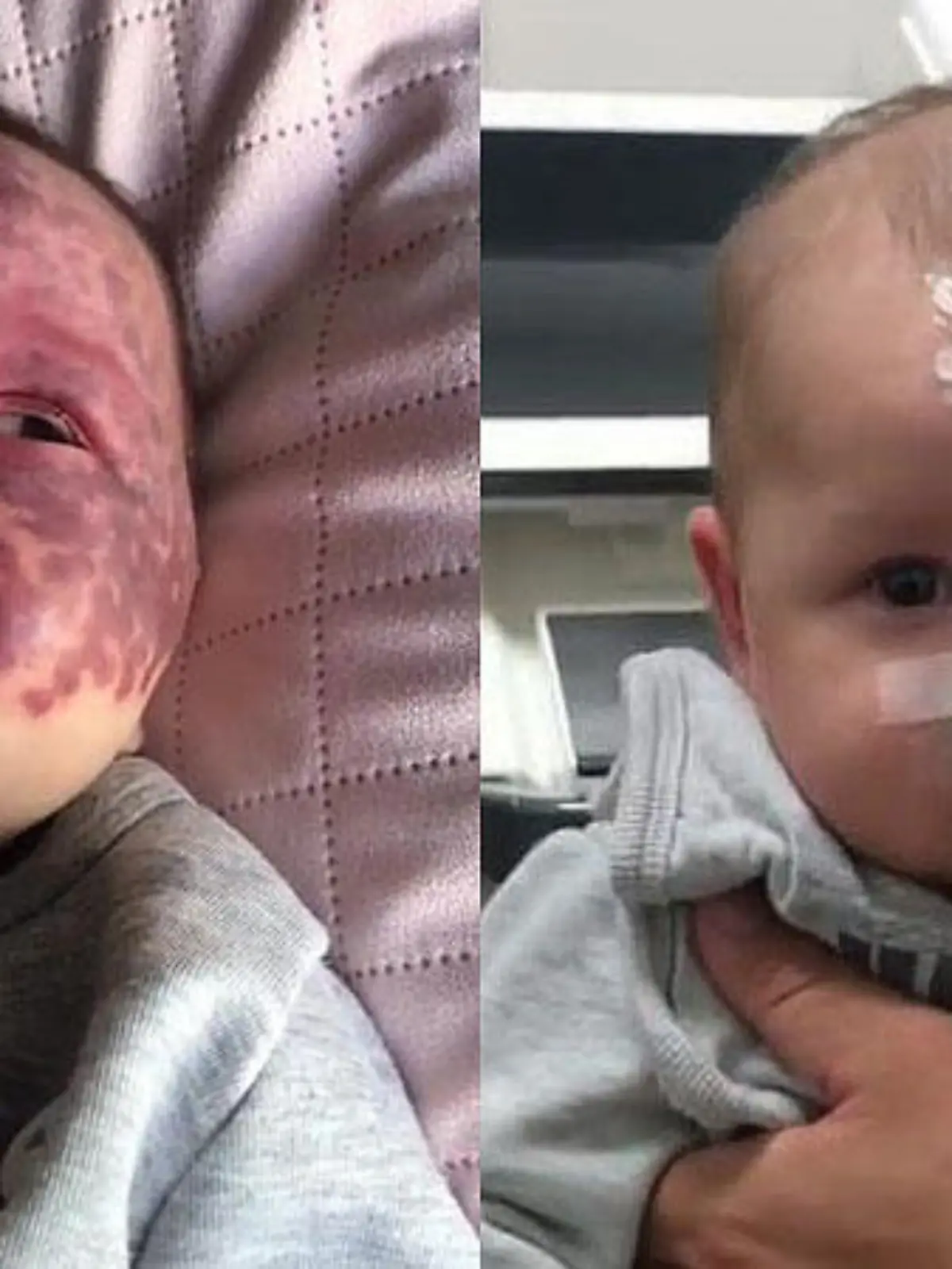 Baby Kingsley wird das Feuermal gelasert - aus präventiven Gründen. Bei TikTok erntet die Mutter deswegen Kritik.