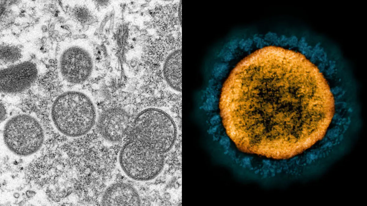 Zwei auf einen Schlag? Experten sagen, dass eine Doppelinfektion von Sars-CoV-2 und dem Affenpocken-Virus möglich ist.