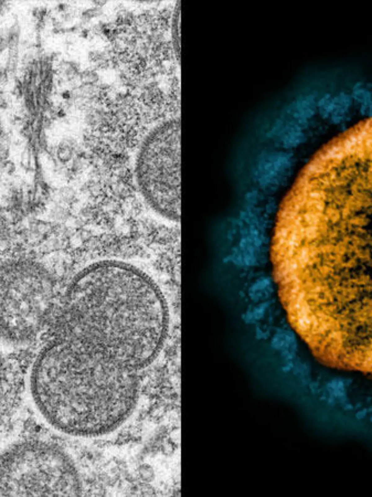 Zwei auf einen Schlag? Experten sagen, dass eine Doppelinfektion von Sars-CoV-2 und dem Affenpocken-Virus möglich ist.