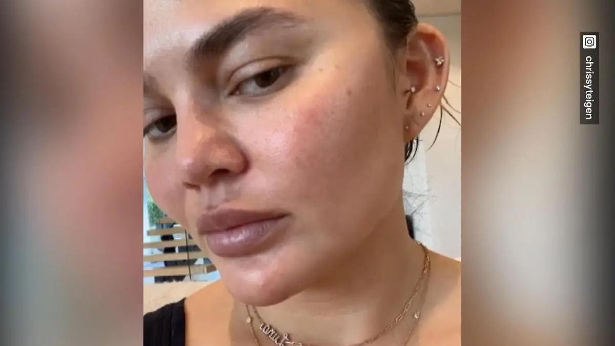 Model Chrissy Teigen zeigt uns ihre unreine Haut Pickel-Alarm!