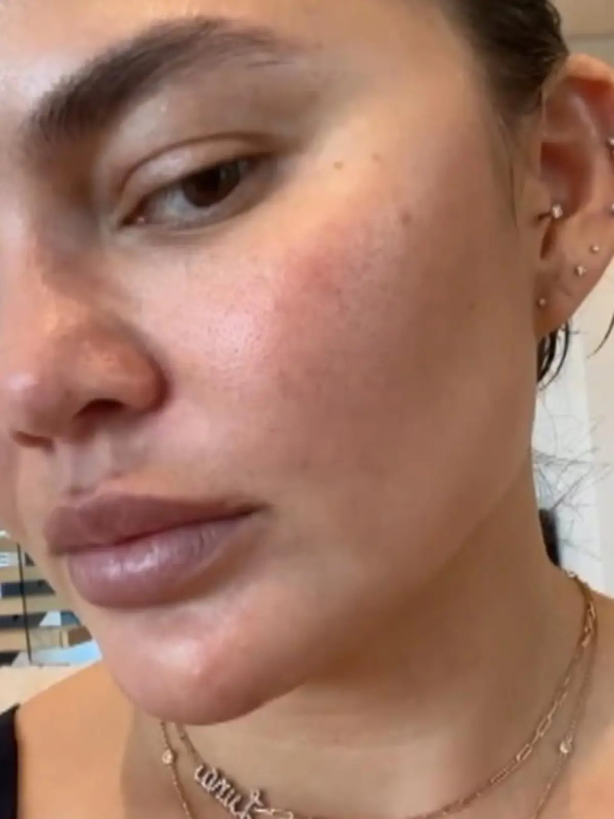 Bild zu: "Model Chrissy Teigen zeigt uns ihre unreine Haut"