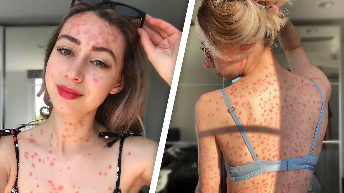 Claires Körper ist von roten Psoriasis-Malen gezeichnet.