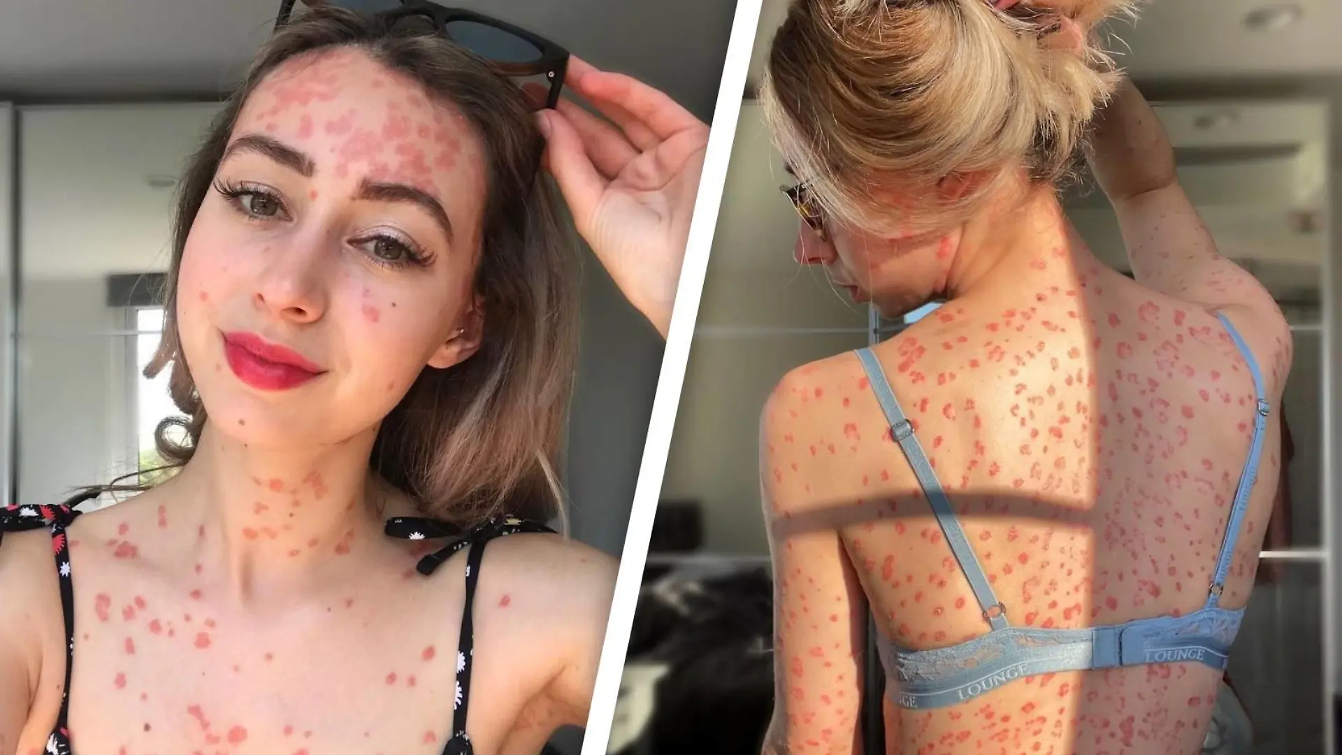 Claires Körper ist von roten Psoriasis-Malen gezeichnet.