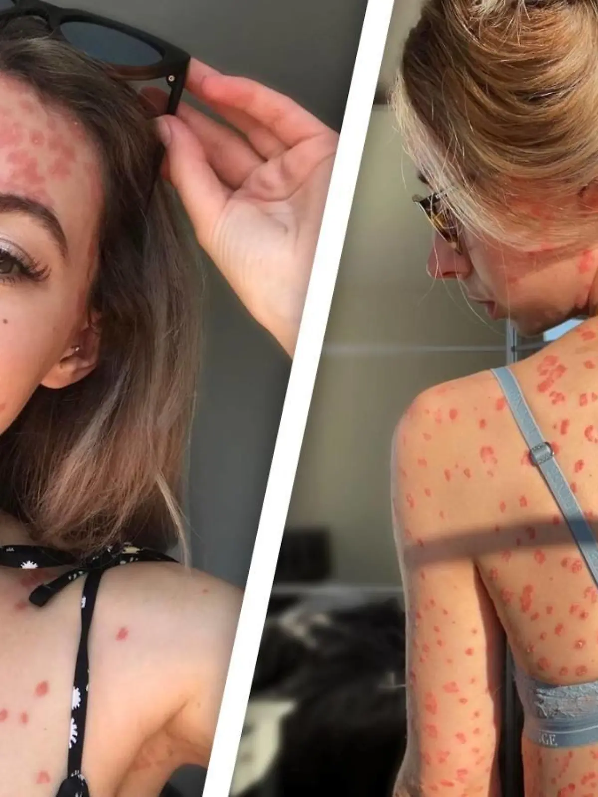 Claires Körper ist von roten Psoriasis-Malen gezeichnet.