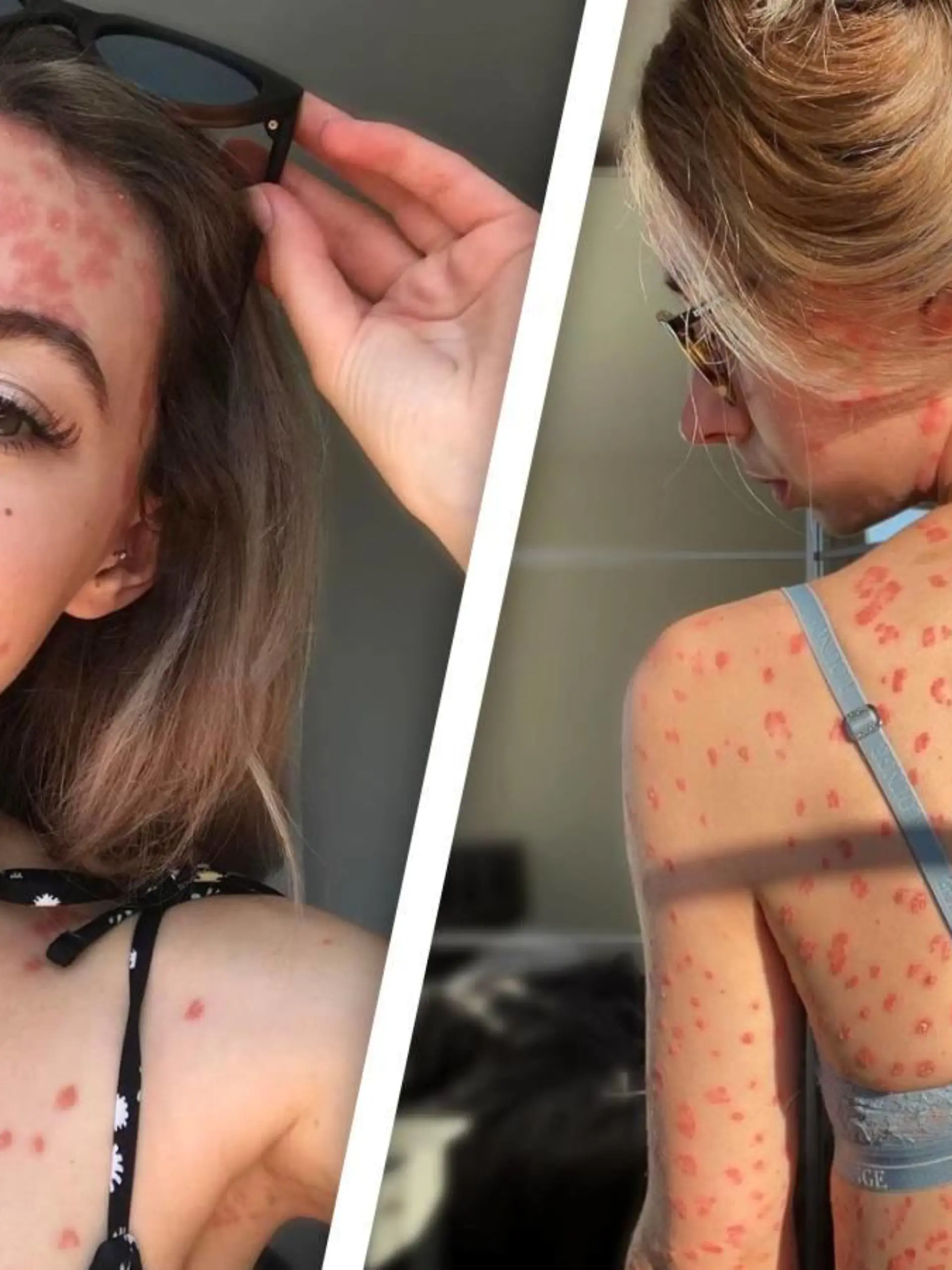 Claires Körper ist von roten Psoriasis-Malen gezeichnet.