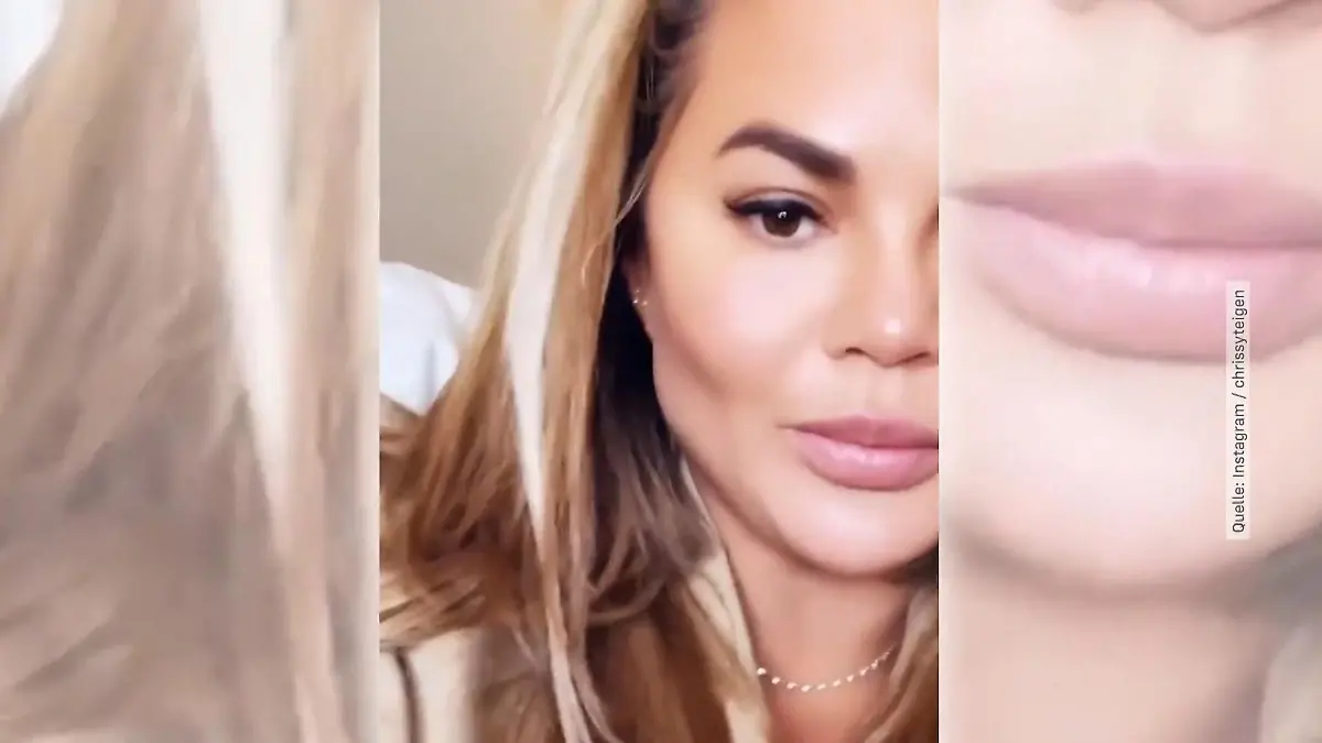 Chrissy Teigen beim Beauty-Doc Fettabsaugung im Gesicht