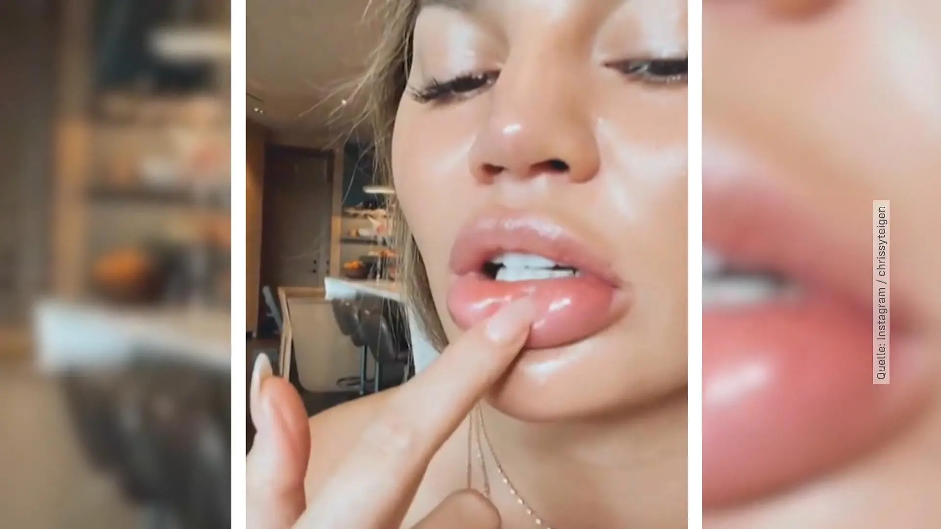 Chrissy Teigen riskiert 'ne dicke Lippe Allergische Reaktion