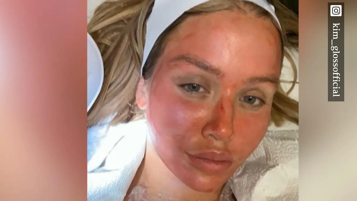 Kim Gloss beim Vampir-Lifting Achtung, es wird blutig!