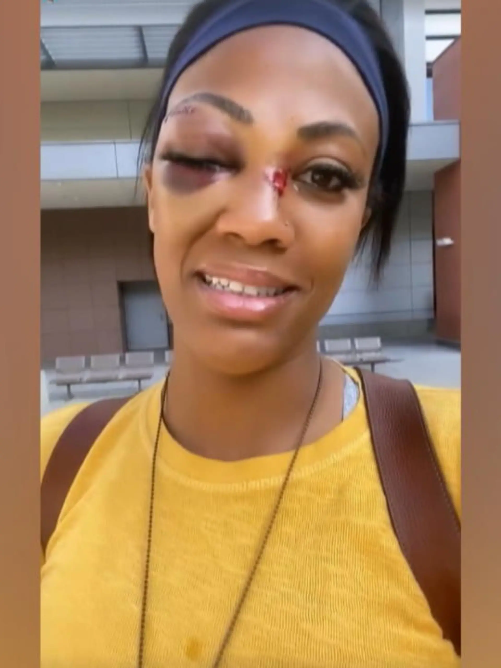 In Los Angeles wurde Kim Glass von einem Obdachlosen mit einem Metallrohr angegriffen. Die ehemalige Vollayball-Olympionikin wäre fast erblindet.