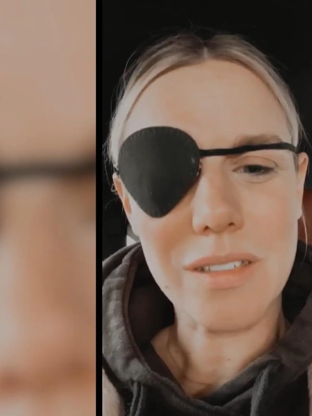 Bild zu: "Sandra Kuhn muss Augenklappe tragen"