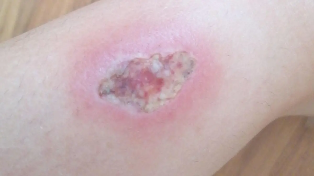 PIC FROM Kennedy News and Media (PICTURED: AN INFECTED SPIDER BITE ON STACEY GRIMES' RIGHT LEG) A mum almost lost her leg after being bitten by a spider at a music festival - leaving her with a wound that became so infected doctors had to cut out a chunk of it while she was awake. Stacey Grimes, from Southend-on-Sea, Essex, claims she had been to The Big 90s Festival in Southend, Essex, with her partner, in October last year, before a mark appeared on her lower right leg. The 33-year-old assumed she must have banged her leg and not realised, mistaking the mark for a bruise. DISCLAIMER: While Kennedy News and Media uses its best endeavours to establish the copyright and authenticity of all pictures supplied, it accepts no liability for any damage, loss or legal action caused by the use of images supplied and the publication of images is solely at your discretion. SEE KENNEDY NEWS COPY - 0161 697 4266