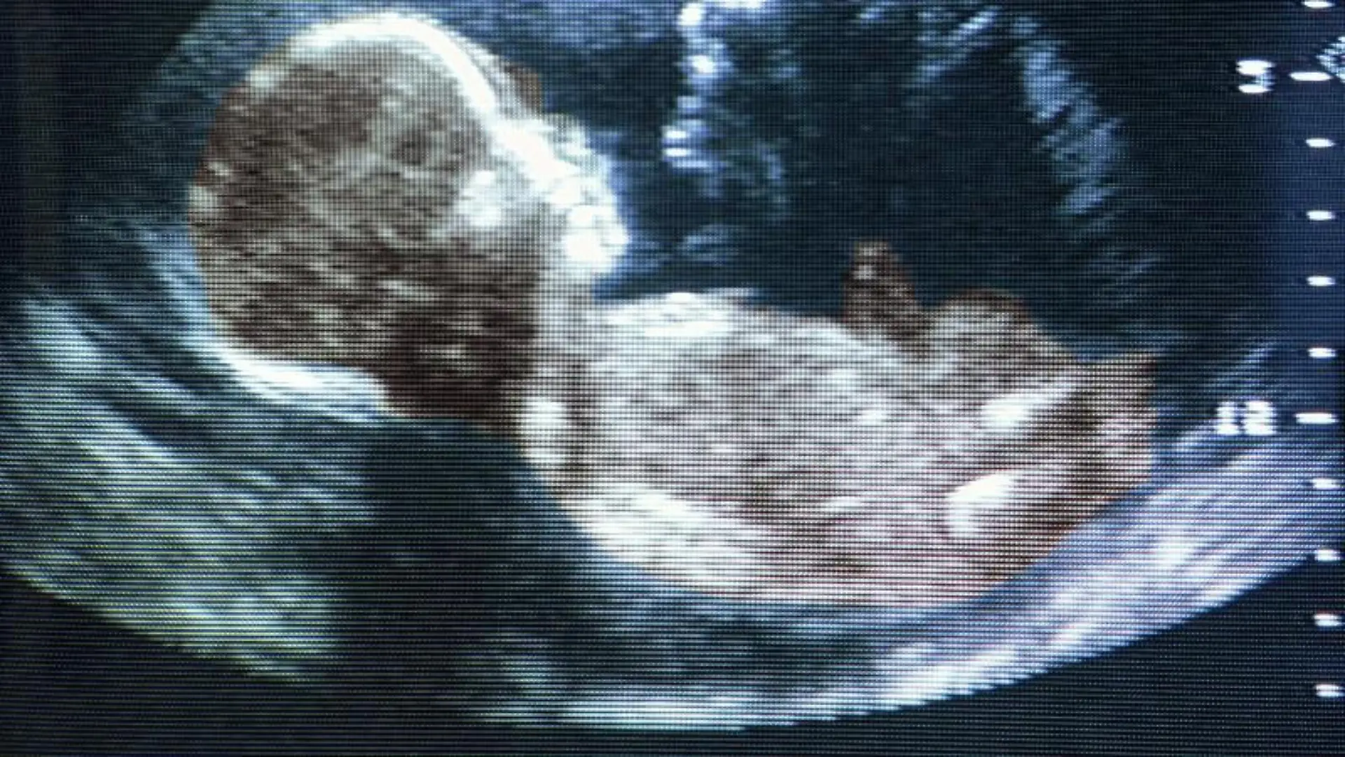 So funktioniert die Nackenfaltenmessung Down-Syndrom beim Baby?