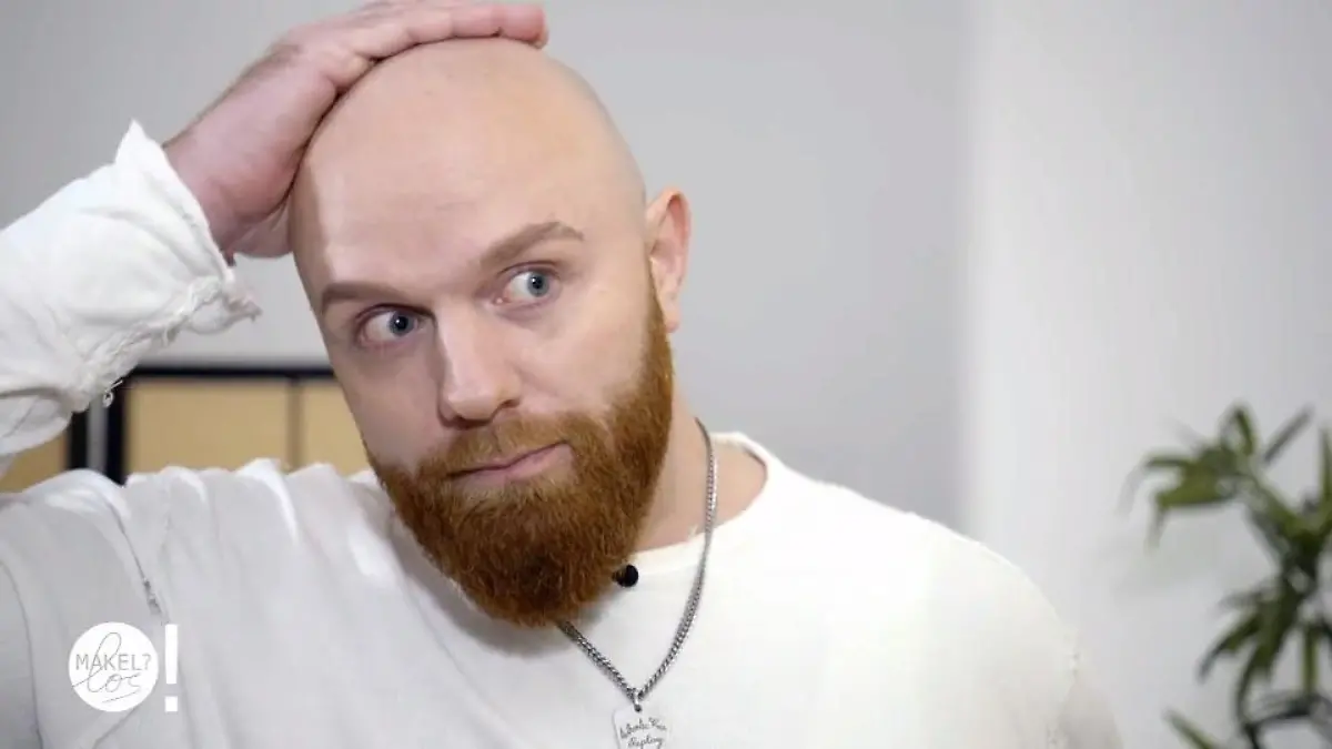 Endlich fühlt sich Marco wieder jünger Ist eine Glatze die Lösung?