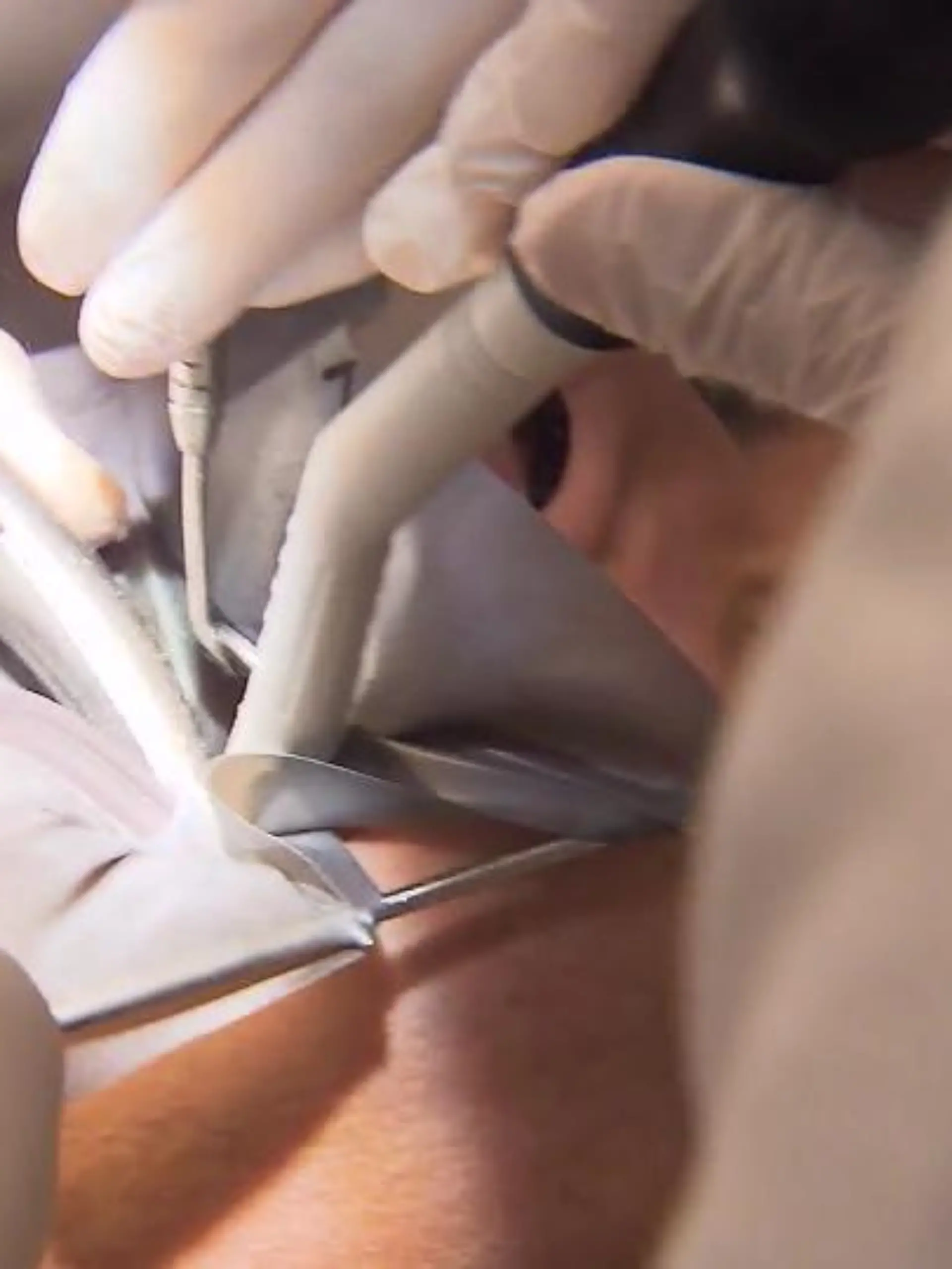 Bild zu: "Patient darf Amalgam nicht verschlucken"